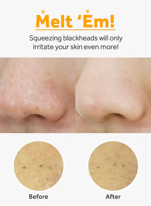 Blackheads_4_2048x2048.webp